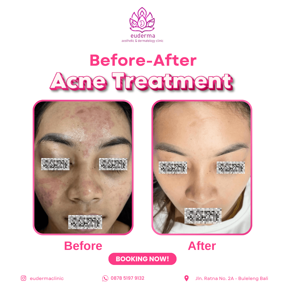 Acne Clear Program