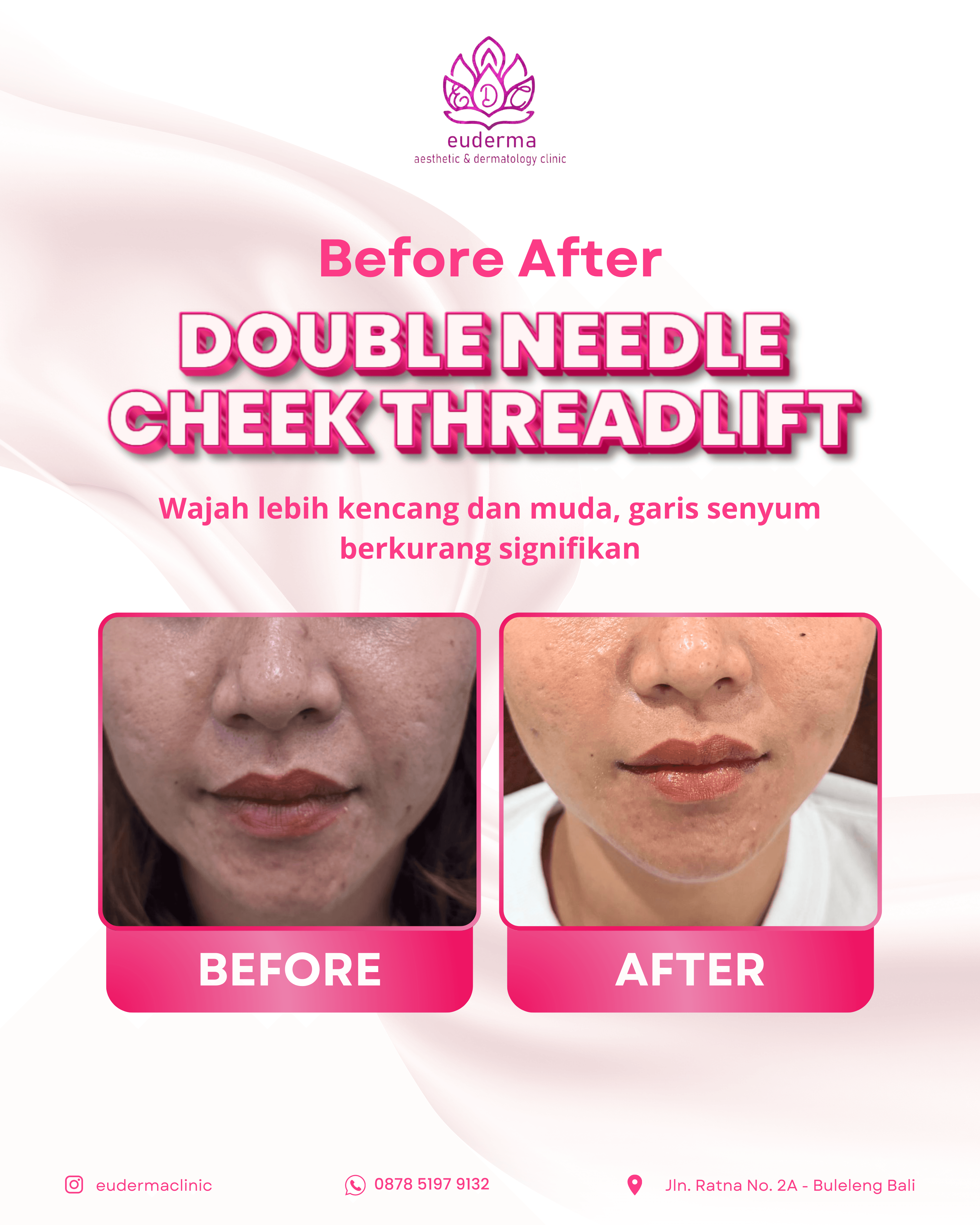 Contouring & Lifting